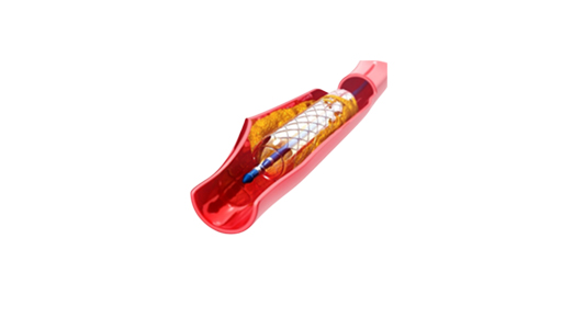 Glue closure system for varicose veins3